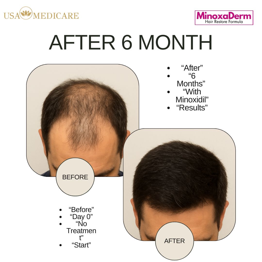 Minoxaderm  Hair Restore Formula (60ml) + Free Derma Roller